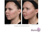 Results using the new Total Tip from Thermage﻿!